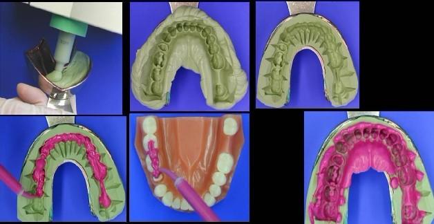 牙科印模膠圖片/牙科印模膠樣板圖 (3)