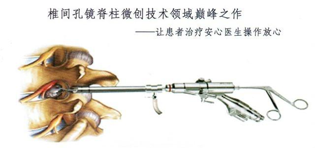 供應(yīng)疼痛椎間孔鏡收費(fèi)，疼痛椎間孔鏡，椎間孔鏡收費(fèi)，椎間孔鏡