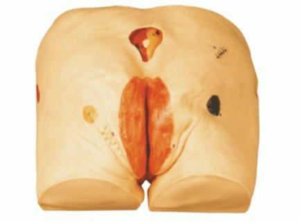 供应高级褥疮护理模型